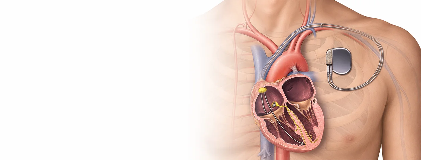 Pacemaker Implantation in Panipat: Symptoms, Procedure & Recovery (2026 Guide)